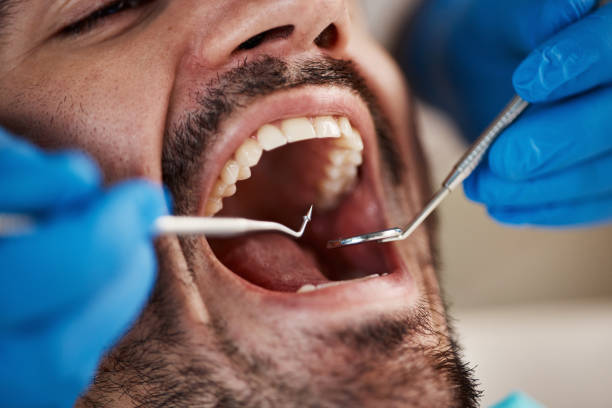 Best Dental Abscess Treatment in Desnso, CA